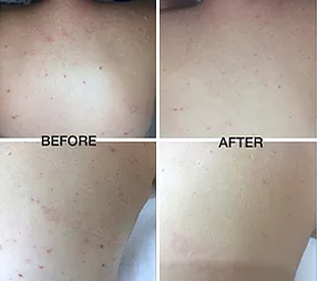 skin treatments Skin Peels Skin Needling