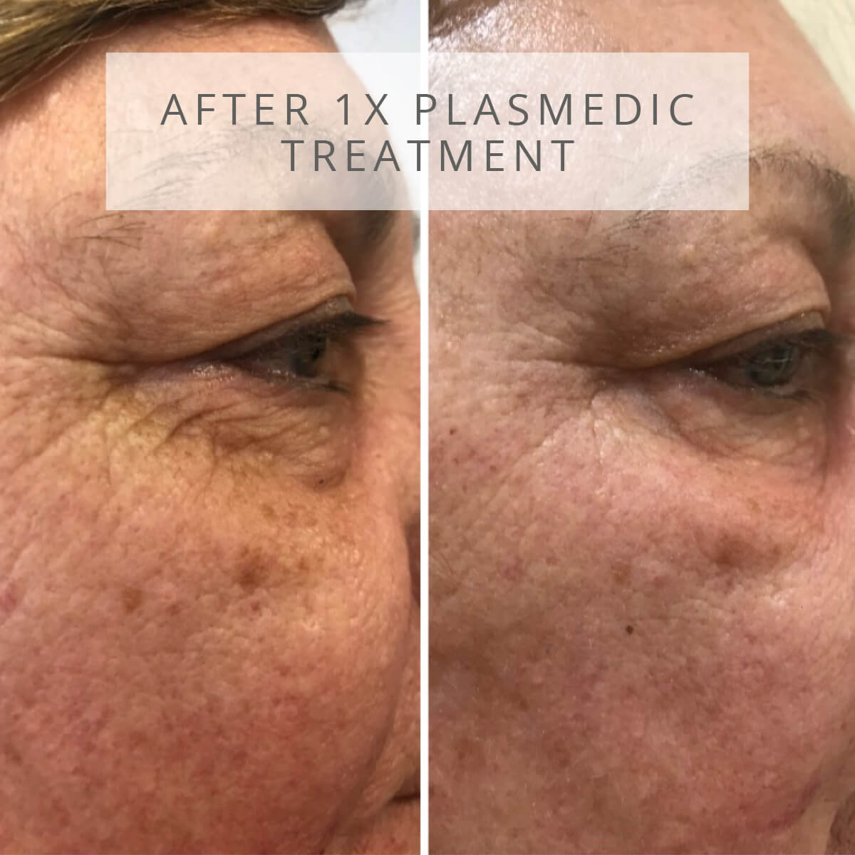 Plasmedic Treatment Before After