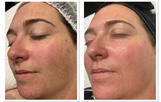 Cosmelan Depigmentation Peel Before After