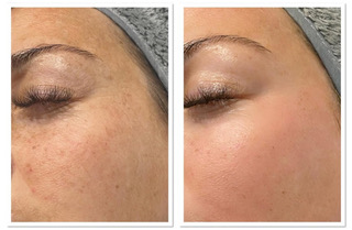 Cosmelan Depigmentation Peel Before After