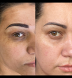 Microdermabrasion Skin Needling Treatments